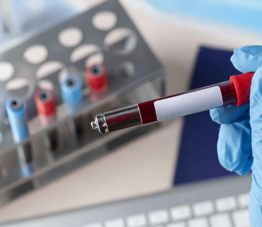AI-Powered Blood Test Could Revolutionize Parkinson’s Detection