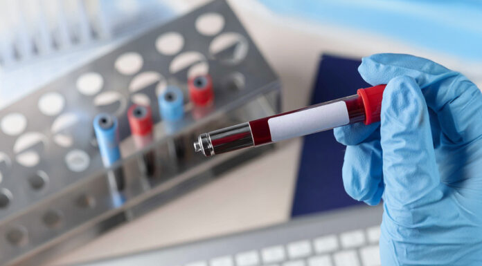 AI-Powered Blood Test Could Revolutionize Parkinson’s Detection